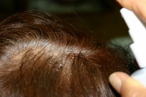 育毛剤は効果がないと諦める前に自分の症状と原因を理解しよう