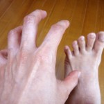 爪水虫の治療とその症状について|治すには何をしたらいいの?