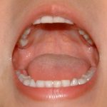 子どもの歯並びの矯正を始める時期は何歳くらいがいいの?